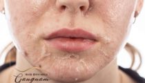 Hiện tượng tăng sắc tố da mặt sau peel