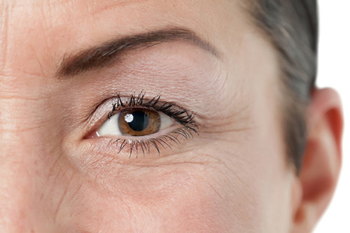 Dấu hiệu nhận biết có vết nhăn vùng mắt
