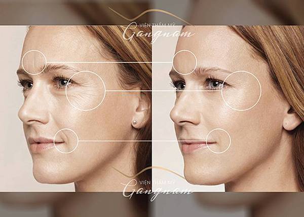 Căng chỉ collagen Gold Fiber cho vùng da mắt săn chắc và không còn nếp nhăn