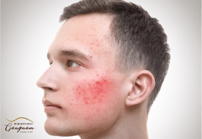Nấm da mặt là bệnh gì?