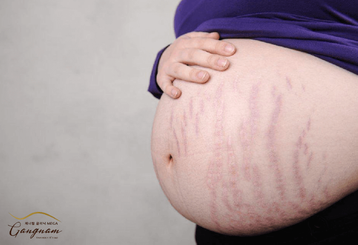 Mang thai - Nguyên nhân của tình trạng rạn da