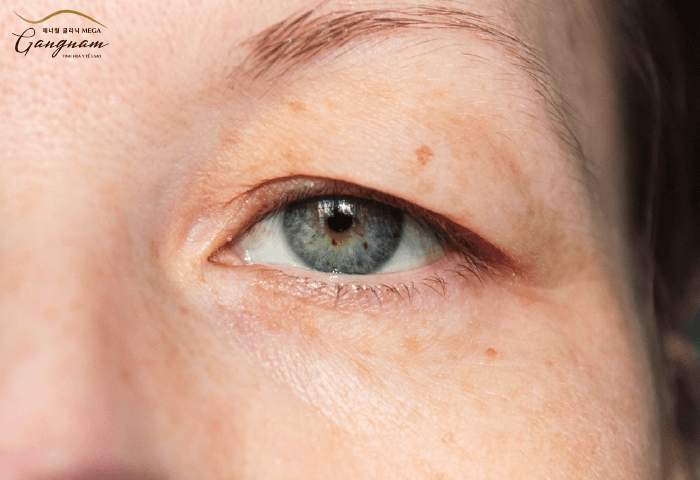 Chùng da mắt là một tình trạng mà da quanh mắt bị lỏng và chùng xuống