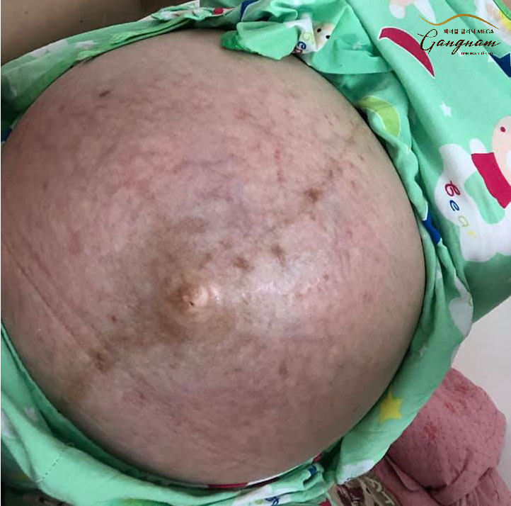 Hình ảnh dạn da khi mang thai là một tình trạng mà nhiều chị em phụ nữ gặp phải