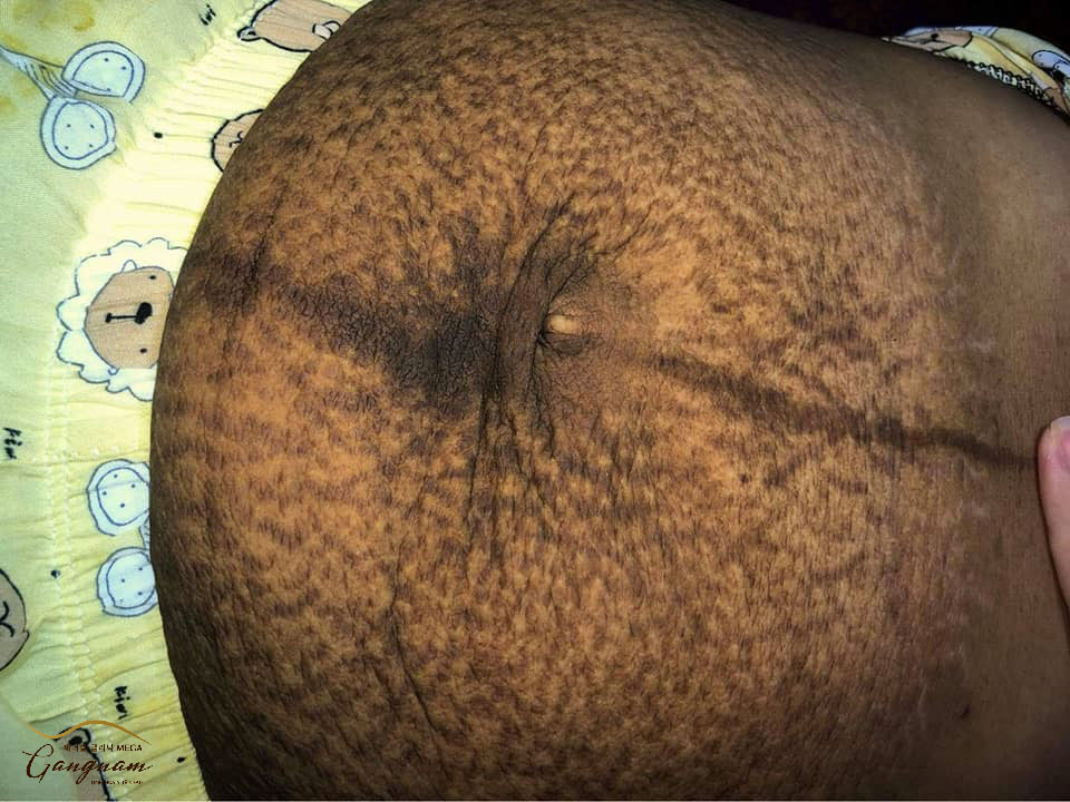 Hình ảnh bụng sau sinh của bà mẹ T.L sau khi mang thai 9 tháng 10 ngày