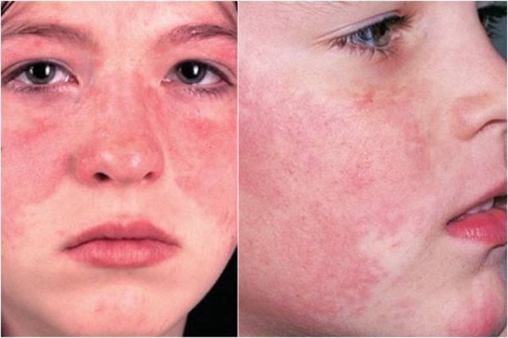 Tình trạng đỏ rát kéo dài là biểu hiện của các biến chứng nặng hơn trên da.