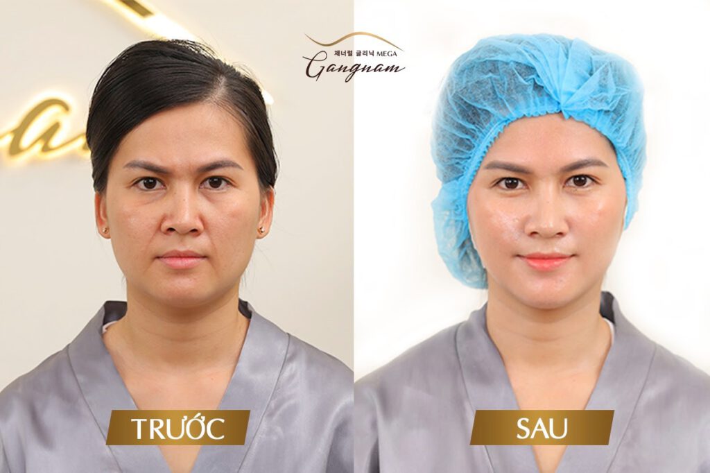 Chị Thu Phương trước và sau khi căng chỉ collagen Gold Fiber 
