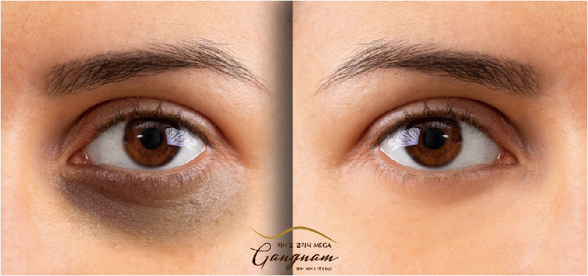 Quầng thâm mắt là tình trạng da xung quanh vùng mắt bị sạm màu,