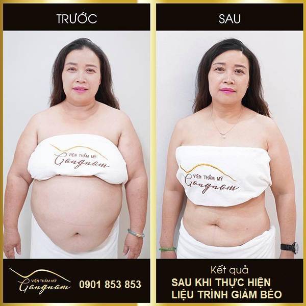 Kết quả sau khi thực hiện giảm cân Smart Lipo của chị Ngọc Huyền - giảm hơn 11kg cân nặng và 27cm vòng bụng. 