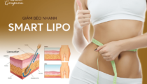 giảm béo nhanh Smart Lipo