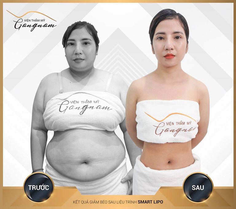 Kết quả giảm béo toàn thân sau liệu trình Smart Lipo tại Mega Gangnam