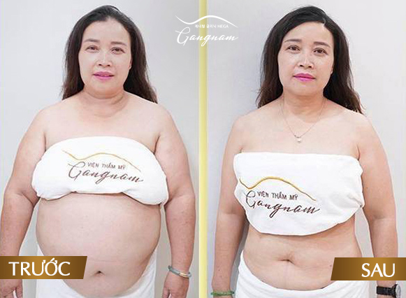 Hình ảnh trước và sau khi giảm mỡ thành công với Smart Lipo, vóc dáng lột xác của khách hàng tại Mega Gangnam 