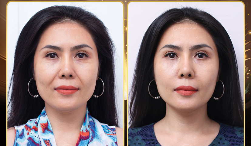 Mrs. Truc Ly completely improved her wrinkles after 3 months, looking many years younger thanks to Mega Fiber Plus