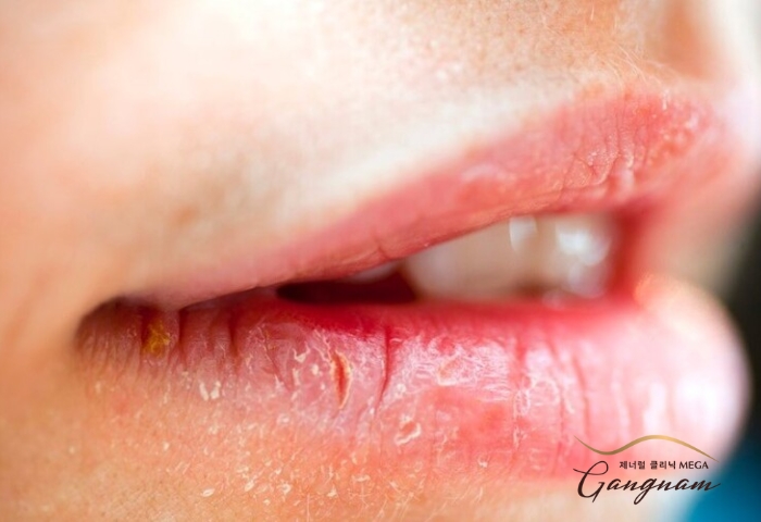 Những phản ứng tiêu cực có thể gặp phải khi phun xăm môi