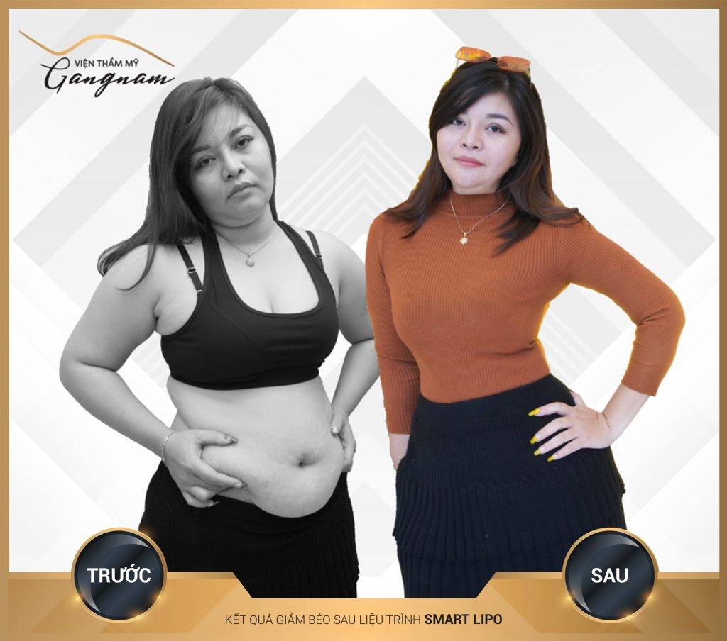 Kết quả sau khi giảm mỡ sau sinh với Smart Lipo, chị Huyền giảm 35cm vòng bụng, về dáng như thời con gái
