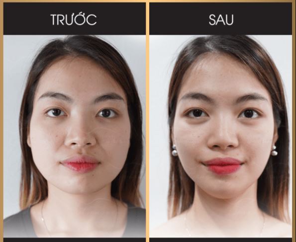 Hiệu quả trước và sau khi giảm mỡ mặt với Smart Lipo 