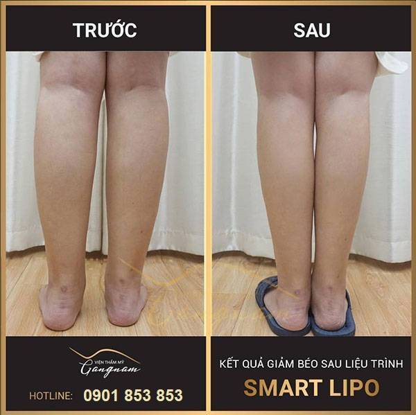Kết quả sau khi giảm mỡ bắp chân của khách hàng sử dụng Smart Lipo