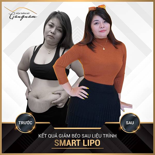 Hiệu quả giảm mỡ đáng kinh ngạc của Smart Lipo chỉ sau1 liệu trình 