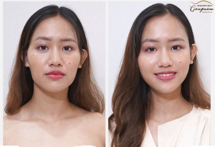 1 CC HA Collagen bao nhiêu tiền?