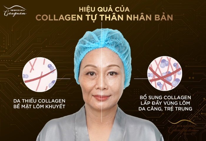 Thực hiện liệu pháp cấy collagen tự thân nhân bản cho thời gian duy trì lâu dài