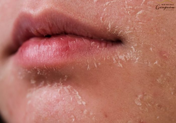 Tại sao da mặt cần được chăm sóc kỹ hơn vào mùa lạnh?