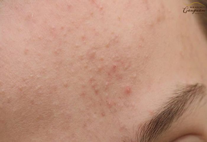 Da mặt sần sùi nhiều mụn cám là gì và có nguy hiểm không?
