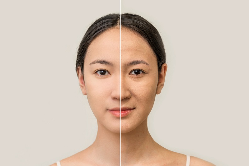 Nâng cơ mặt khi bạn cảm thấy những sự thay đổi của tuổi tác, làn da..