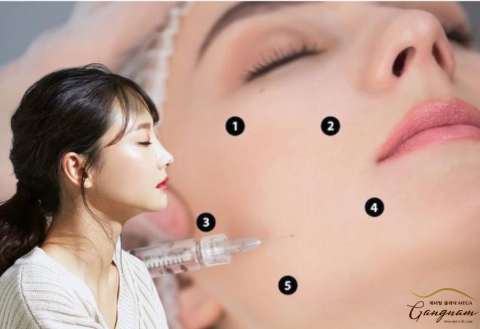 Những lợi ích của kỹ thuật tiêm dưới da mặt