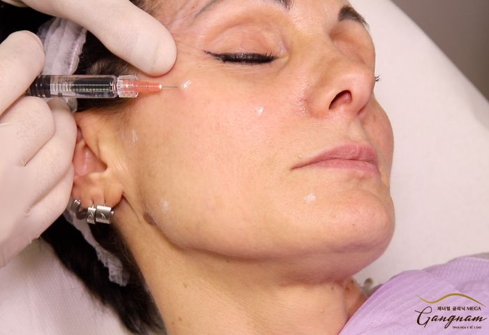 Kỹ thuật tiêm dưới da mặt là gì?