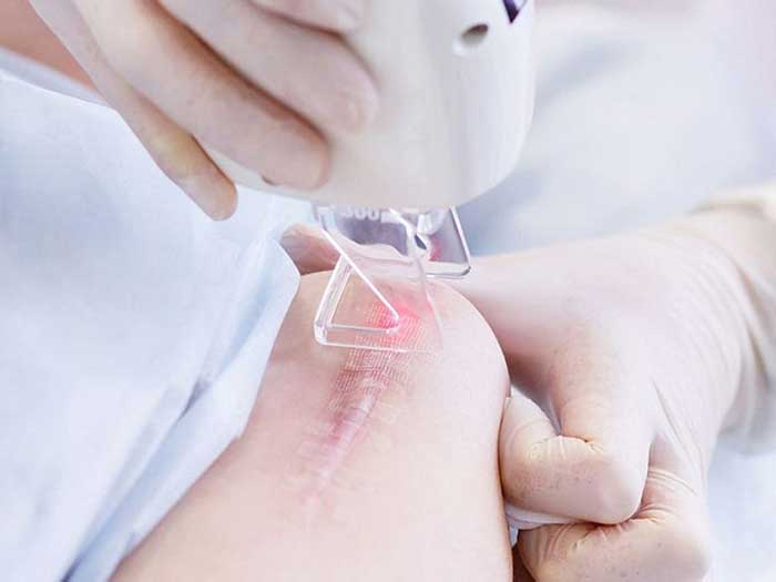 Ứng dụng laser được sử dụng nhiều trong điều trị sẹo lồi 