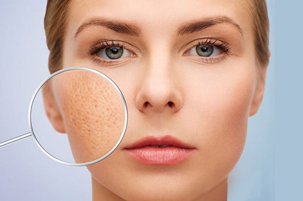Sự tổn thương cấu trúc tế bào da khiến da hình thành sẹo rỗ, lõm lại.