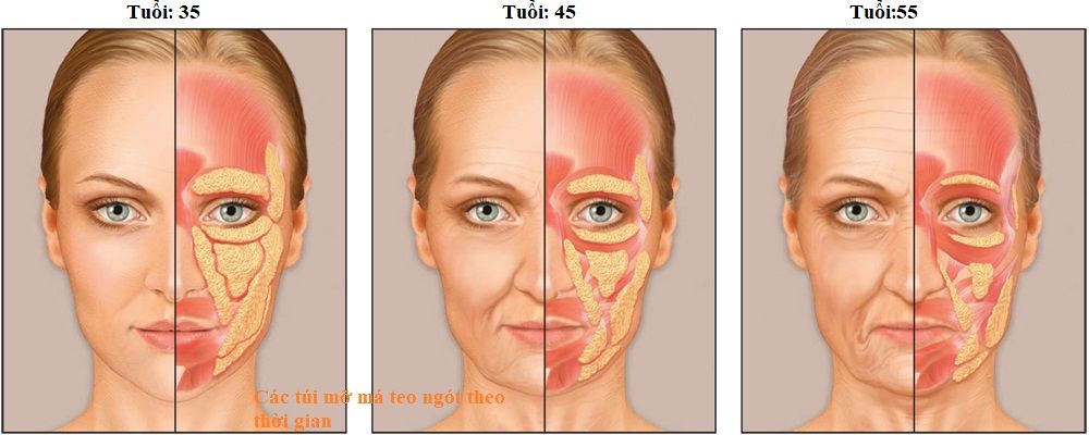 Mỗi một năm làn da của chúng ta sẽ mất đi một chút tế bào liên kết và giảm khối lượng mỡ má