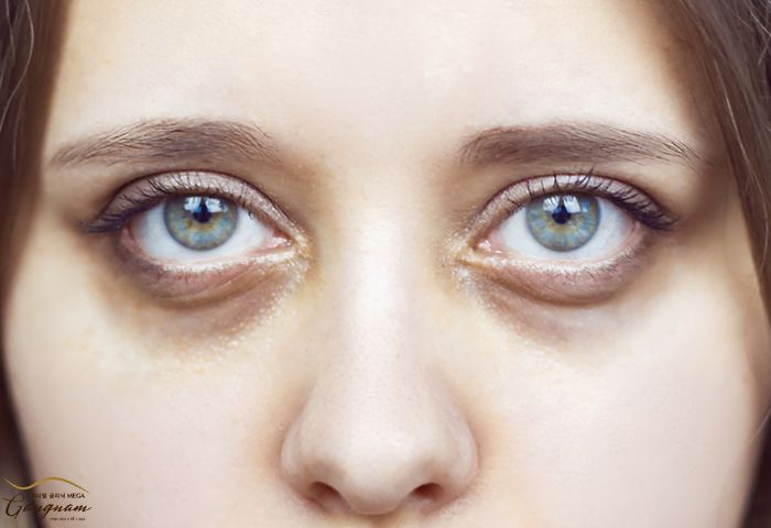 Tại sao nên điều trị quầng thâm mắt?