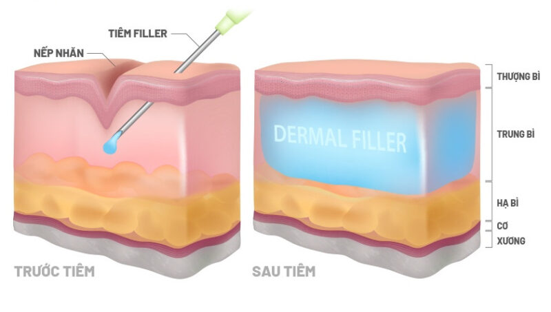 Filler làm từ gì? Tác dụng và phân loại thực tế