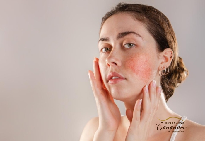 Những yếu tố dẫn đến sự xuất hiện của các vùng da bị chàm trên mặt