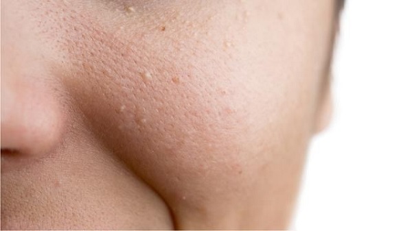 Biểu hiện của làn da bị lỗ chân lông to bề mặt da sần sùi