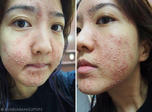 Da mặt của một blogger Singapore sau khi lột da mặt