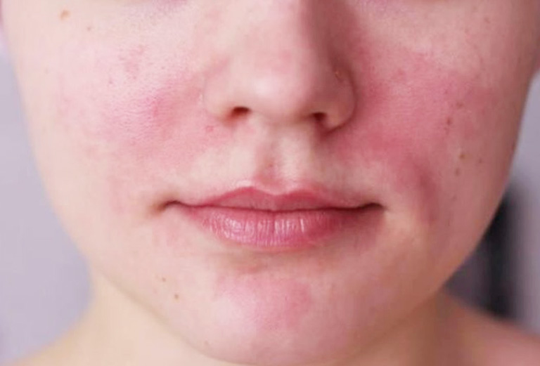 Tình trạng da kích ứng là biểu hiện thường gặp sau khi lột da mặt