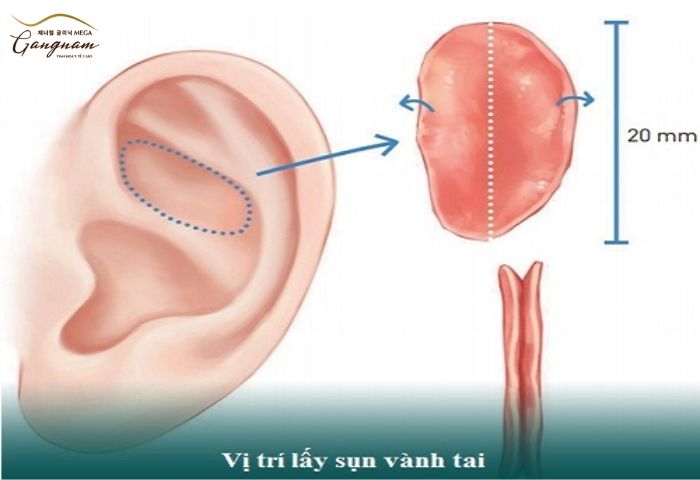 Các yếu tố ảnh hình đến qua trình hồi phục khi lấy sụn tai