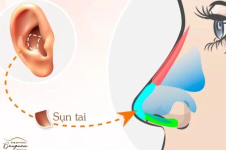 Nâng mũi bọc sụn tai là gì?