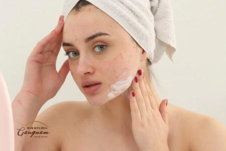 Nặn mụn xong nên bôi gì lên da để không bị thâm sẹo?
