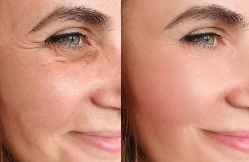Tác dụng khi tiêm filler thay đổi các đường nét trên gương mặt