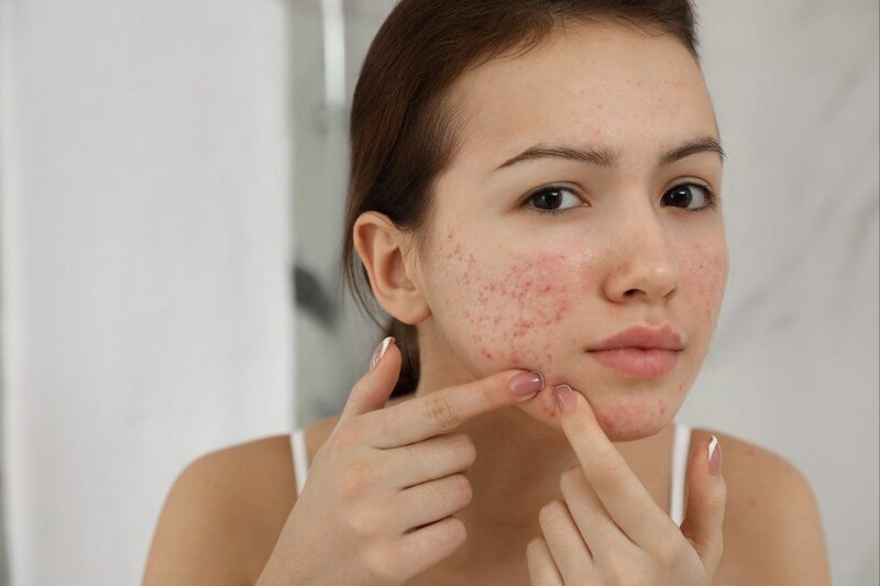 Vệ sinh da không đúng cách hoặc dùng mỹ phẩm kém chất lượng cũng làm cho da mặt nhiễm nấm
