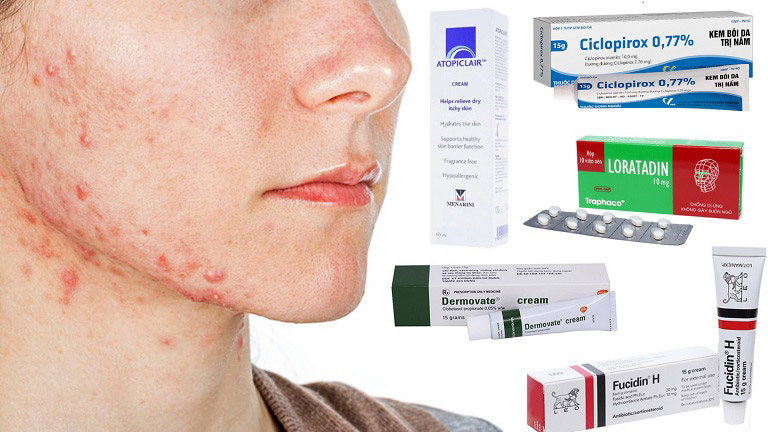 Một số thuốc điều trị gợi ý điều trị nấm da vùng mặt