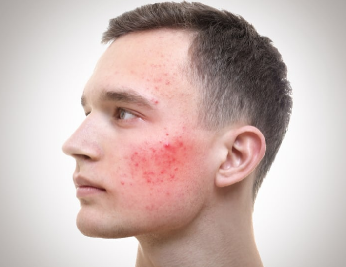 Tình trạng nhiễm khuẩn gây ra bệnh nấm da mặt