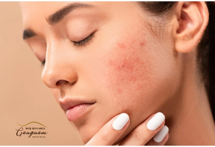 Để loại bỏ các vết thâm trên da mặt nên áp dụng phương pháp nào?