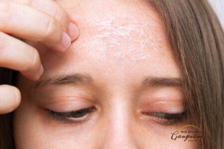 Bệnh vảy nến da mặt là gì? Tìm hiểu nguyên nhân và cách điều trị