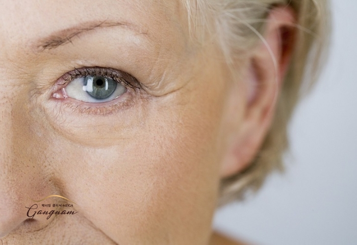 Nguyên nhân gây ra nếp nhăn ở mắt và ăn gì để giảm nếp nhăn vùng mắt?