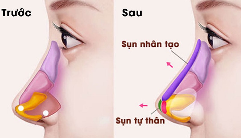 Sụn nhân tạo được ứng dụng nhiều nhất trong nâng mũi