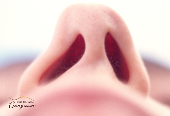 Hiện tượng lệch vách ngăn mũi là gì? Biểu hiện và cách khắc phục