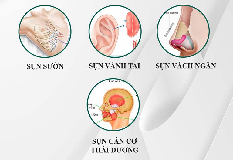 Kỹ thuật nâng mũi căng cơ thái dương là gì?